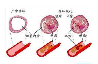 導(dǎo)致心腦血管疾病發(fā)作的因素