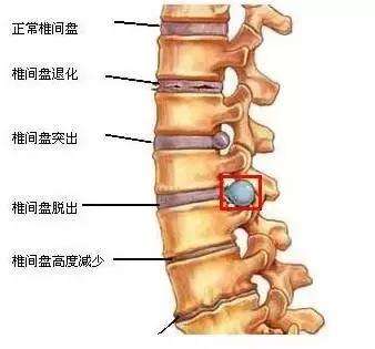 腰椎間盤(pán)突出癥-玄鹿中頻微電腦治療儀