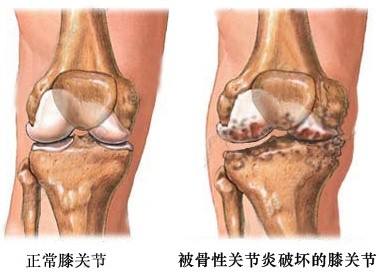 膝骨關(guān)節(jié)炎.jpg