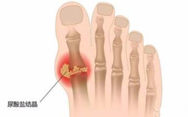 痛風(fēng)早期癥狀有哪些—玄鹿中頻選穴治療儀