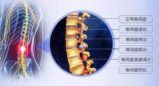 腰椎間盤突出