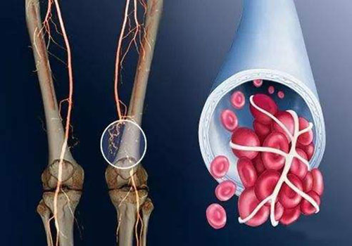 血栓危害人體怎么辦