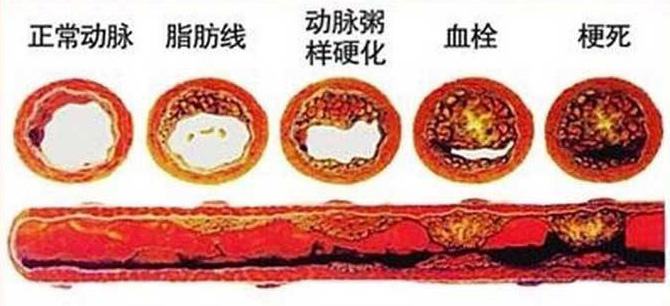 血栓在哪，病就在哪！該怎么清除血栓呢？