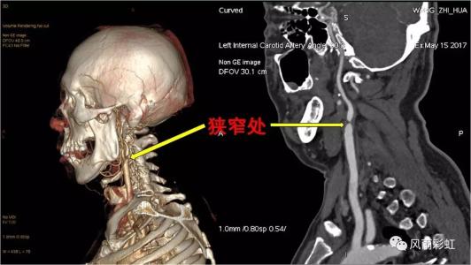 頸椎病都是“積”出來的，4個傷頸的行為，別總是做